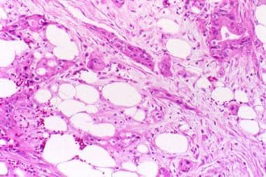 Pancreatic cancer. Hematoxylin and eosin stain of 