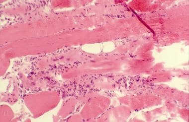 多肌炎。组织病理学切片显示子宫内膜缺失