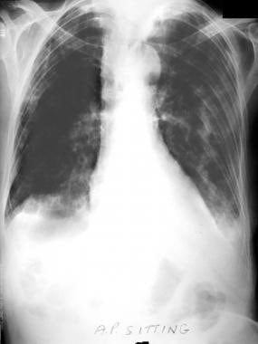 Multiple left rib fractures, pulmonary contusion, 