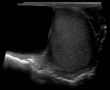 A scrotal ultrasound demonstrating a spermatocele 