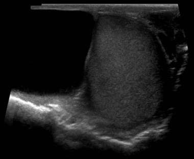Сперматоцеле после. Новообразование на яичке. Сперматоцеле яичка УЗИ.