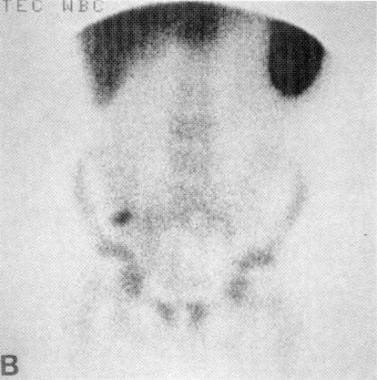 Technetium-99m radionuclide scan of the abdomen sh