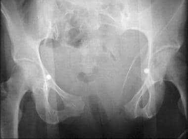 Anterior-posterior (AP) compression pelvic fractur