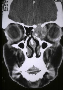 CT scan coronal view demonstrating an osteosarcoma