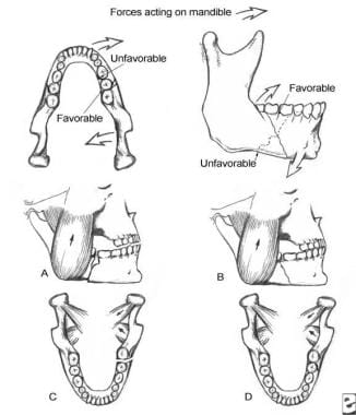 Forces acting on the mandible and demonstration of