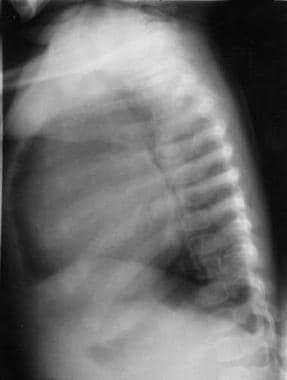 Endocardial Fibroelastosis. Chest radiograph, left