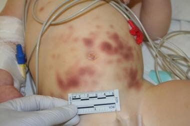 Abdominal bruising in a toddler who also had a liv
