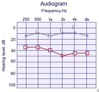 Audiogram 1 year later of the same child as in the