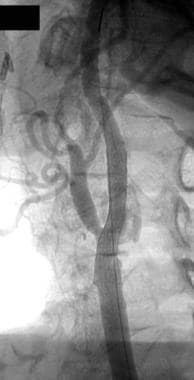 Carotid stent placement. This carotid stent has su