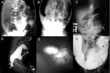 A: Plain abdominal radiograph showing a transition