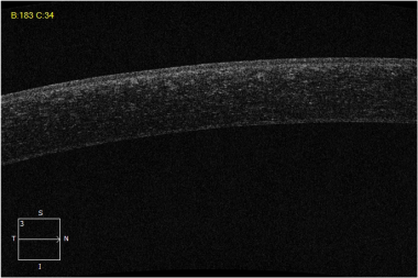 Ocular coherence tomography (OCT) image of the sam