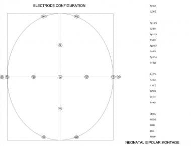 Electrode map and montage. 