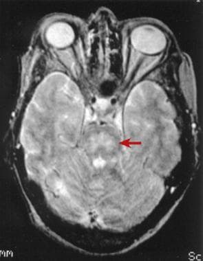 T2-weighted MRI scan of the brain demonstrating pa