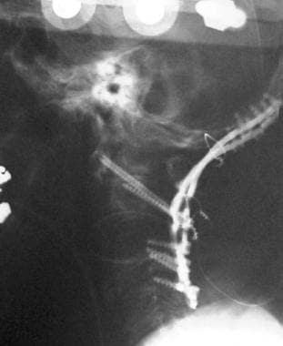 Rheumatoid spondylitis. Occipitocervical fusion co