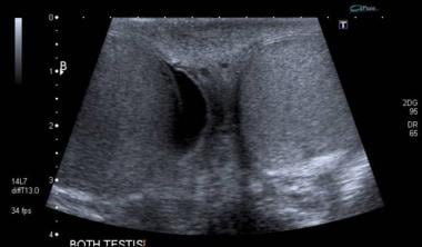 Bilateral view of the testes across the median rap