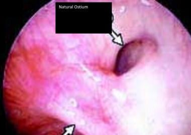 Endoscopic view of the natural maxillary sinus ost