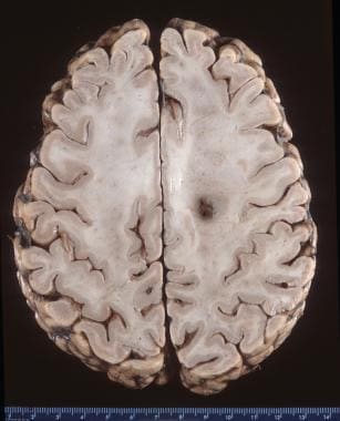 Axial section of a brain exhibiting a frontal lobe