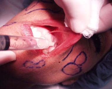 Intraoral approach for an infraorbital block. 