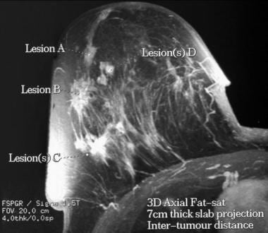 Mammogram Vs. Breast MRI: What's the Difference? - Intercoastal