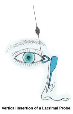 Insertion of lacrimal probe. 