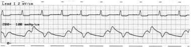 Intra-aortic balloon pressure tracing showing the 