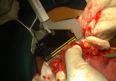 Subtotal gastrectomy in progress. Linear stapler u
