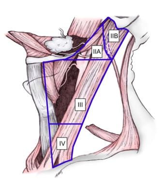 Lateral neck dissection. 