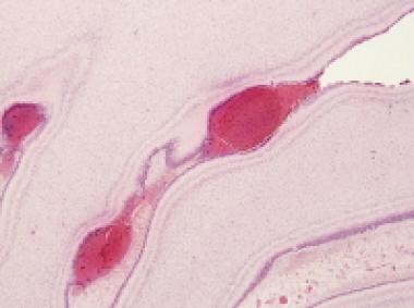 Microscopic appearance of cerebellar external gran