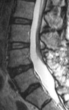 Sagittal T2-weighted MRI of the lumbar spine after