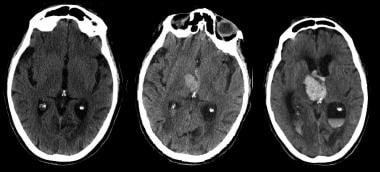 Thrombolytic therapy carries a small but significa