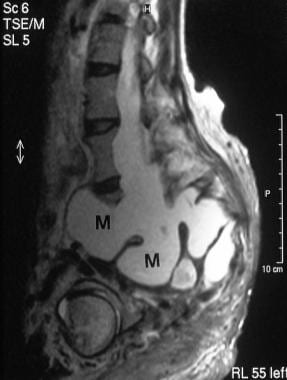 Sagittal T1-weighted unenhanced MRI scan in a 28-y