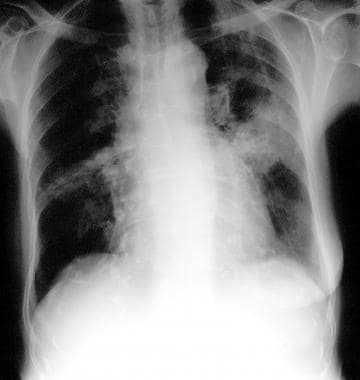 Chest radiograph in an 81-year-old woman with mitr