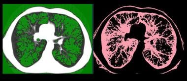 CT Densitovolumetry显示衰减掩模。GR.