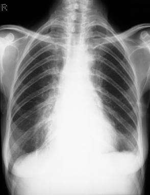 Standard chest radiograph shows mediastinal fibros