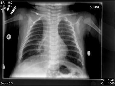 necrotizing pneumonia radiology