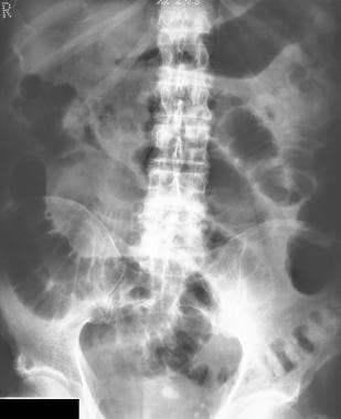 Plain abdominal radiograph in a patient with a cli