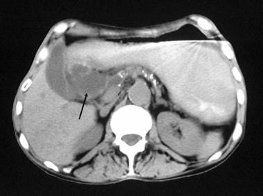 Chronic pancreatitis. Nonenhanced axial CT scan th