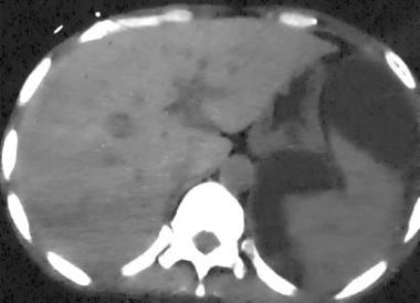 Spleen, trauma. Contrast-enhanced CT scan of the a