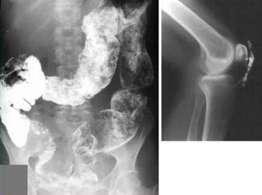 Large bowel barium study in a patient with known g