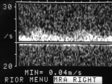 Spectral Doppler ultrasonographic waveform of the 