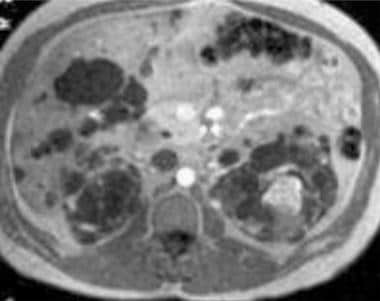Case 19. Left renal cell carcinoma in a patient wi
