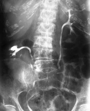 A 62-year-old woman who presented with right iliac