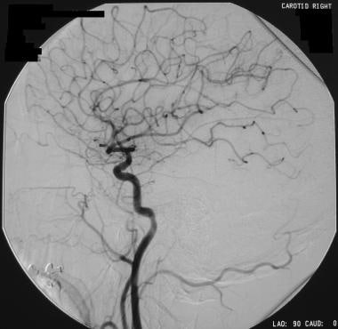 One-month follow-up angiogram in a patient who had
