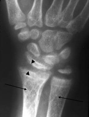 Anteroposterior radiograph of the wrist in a child