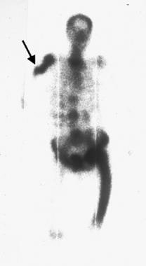 Whole-body bone scan in a patient with polyostotic