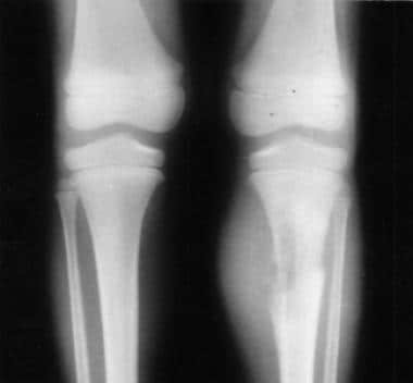 A 5-year-old girl with left leg pain. Anteroposter