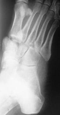 Fractured metatarsals. Image shows a Lisfranc disl