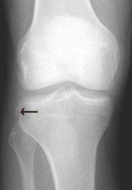 Segond fracture. Anteroposterior (AP) knee radiogr