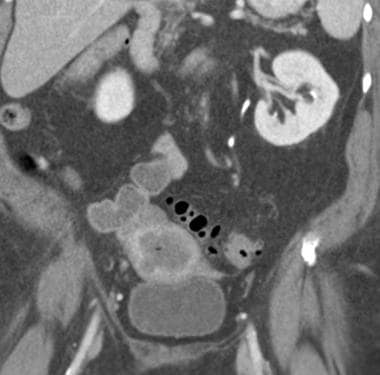 Coronal CT images of a 79-year-old woman with feve