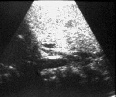 Intact inferior cava. Sagittal ultrasonogram of th